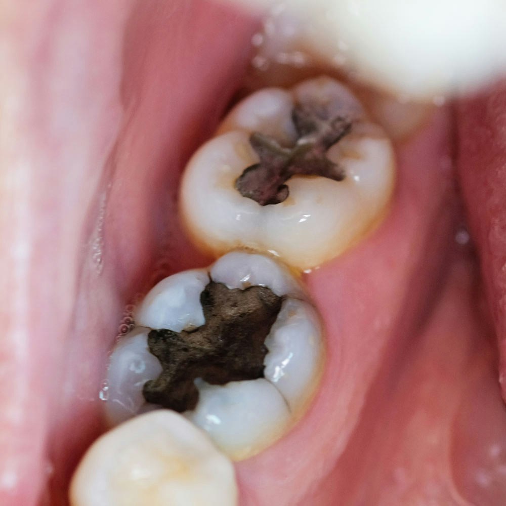 Dental fillings needed for teeth