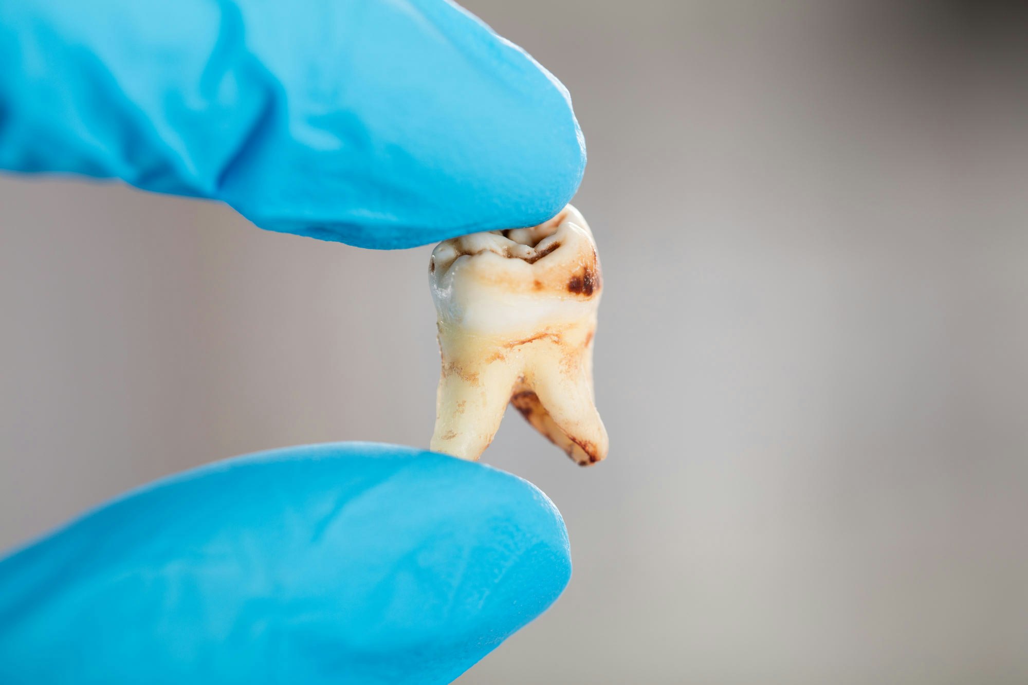 Dentist holding decayed tooth