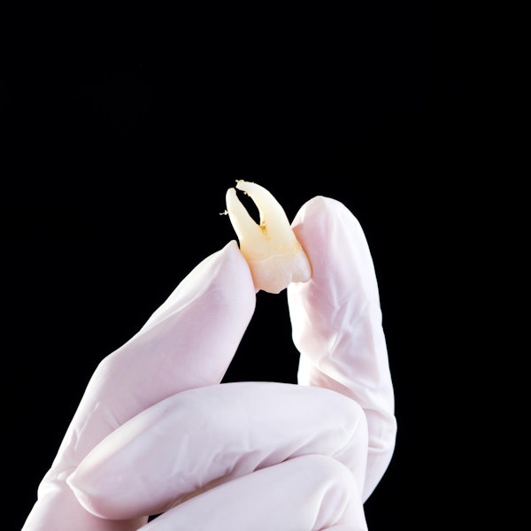 Person holding extracted tooth