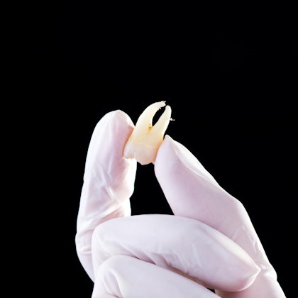 Extracted tooth