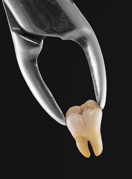 Extracted tooth