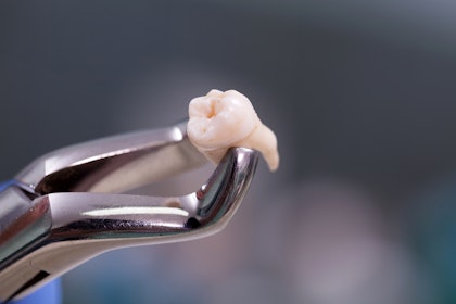 forceps holding extracted wisdom tooth