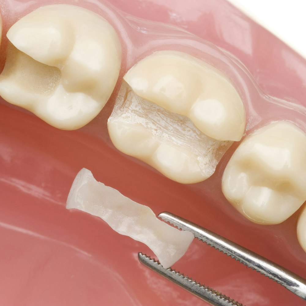 Tooth-colored filling