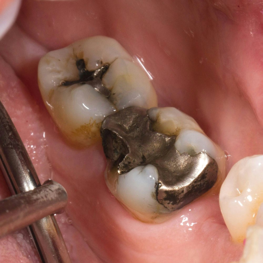 Fractured fillings