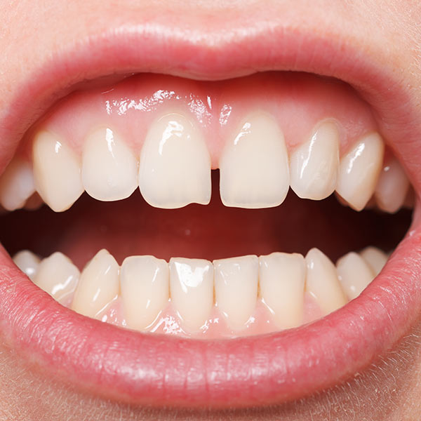 Get Your Invisalign Clear Braces at Our Ideal Smile Philadelphia