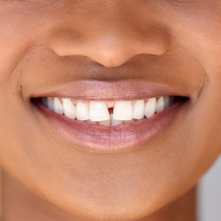 Gap in between front teeth