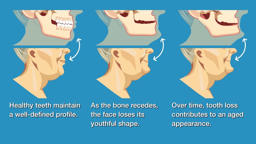Illustration of progression of jawbone atrophy