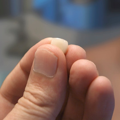 Broken tooth in person's hand