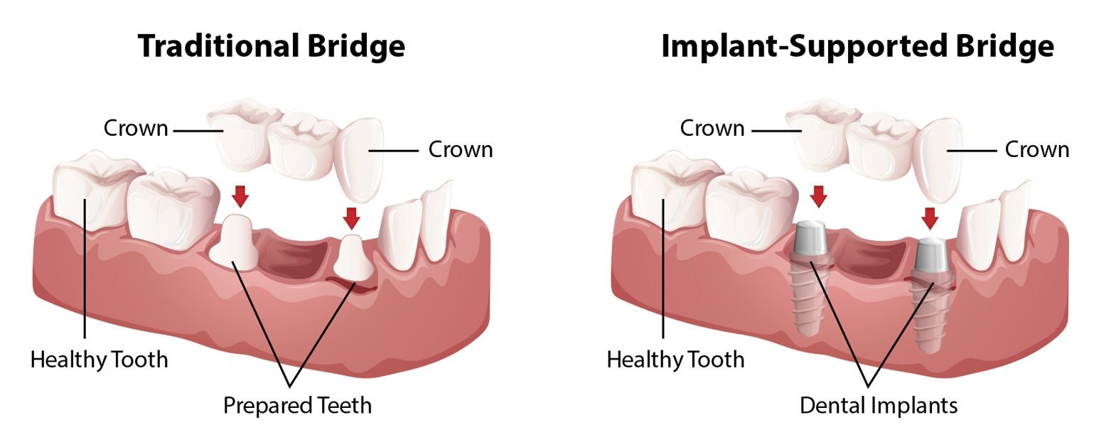 Tradtional bridge vs. implant-supported bridge