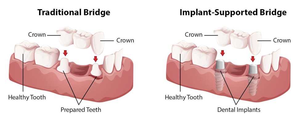 Traditional bridge vs. implant-supported bridge.