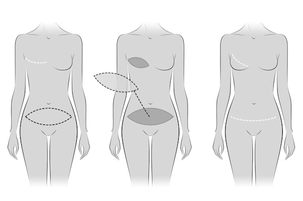Tram flap reconstruction diagram, taking tissue from abdomen