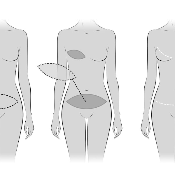 Tram flap reconstruction diagram, taking tissue from abdomen