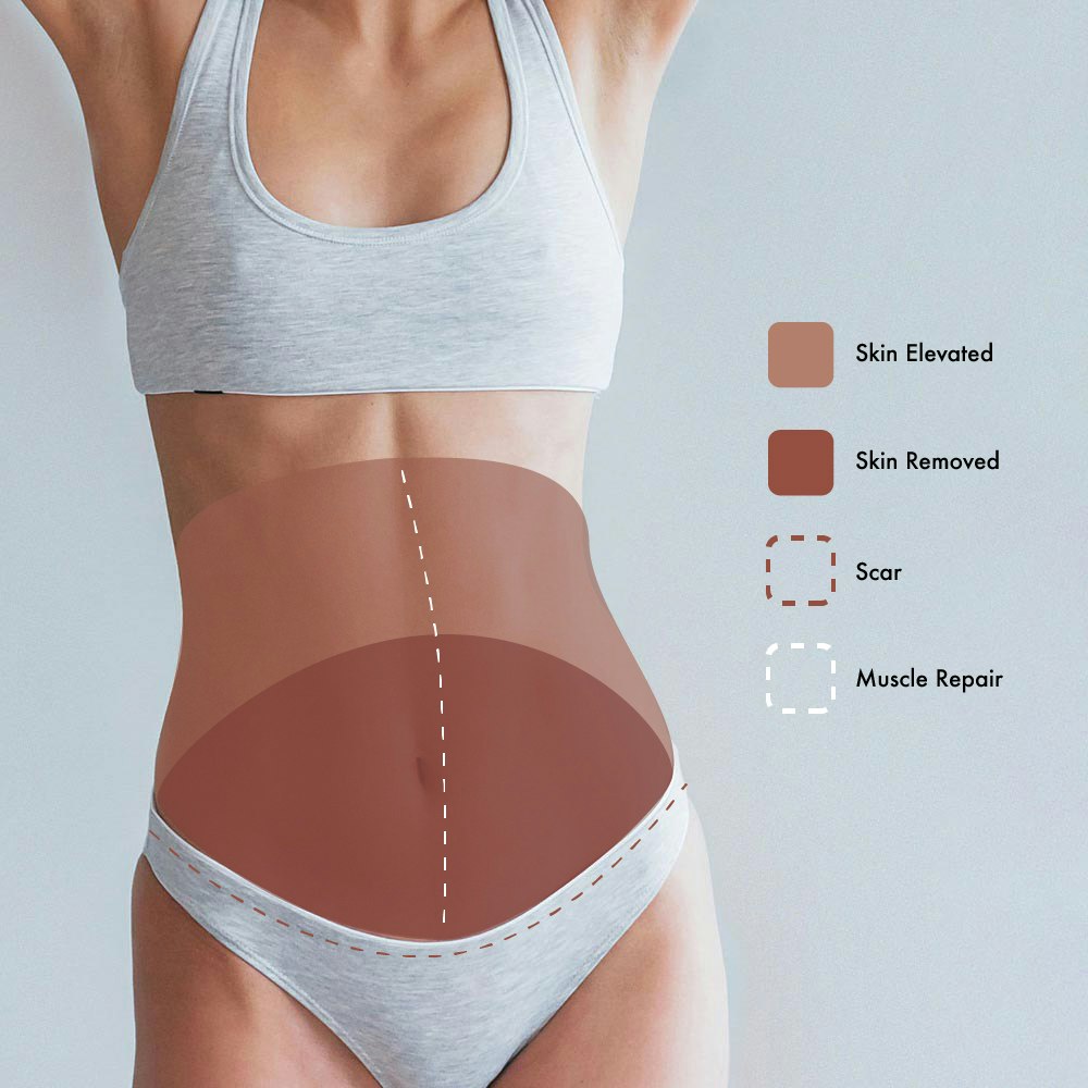 Extended Tummy Tuck