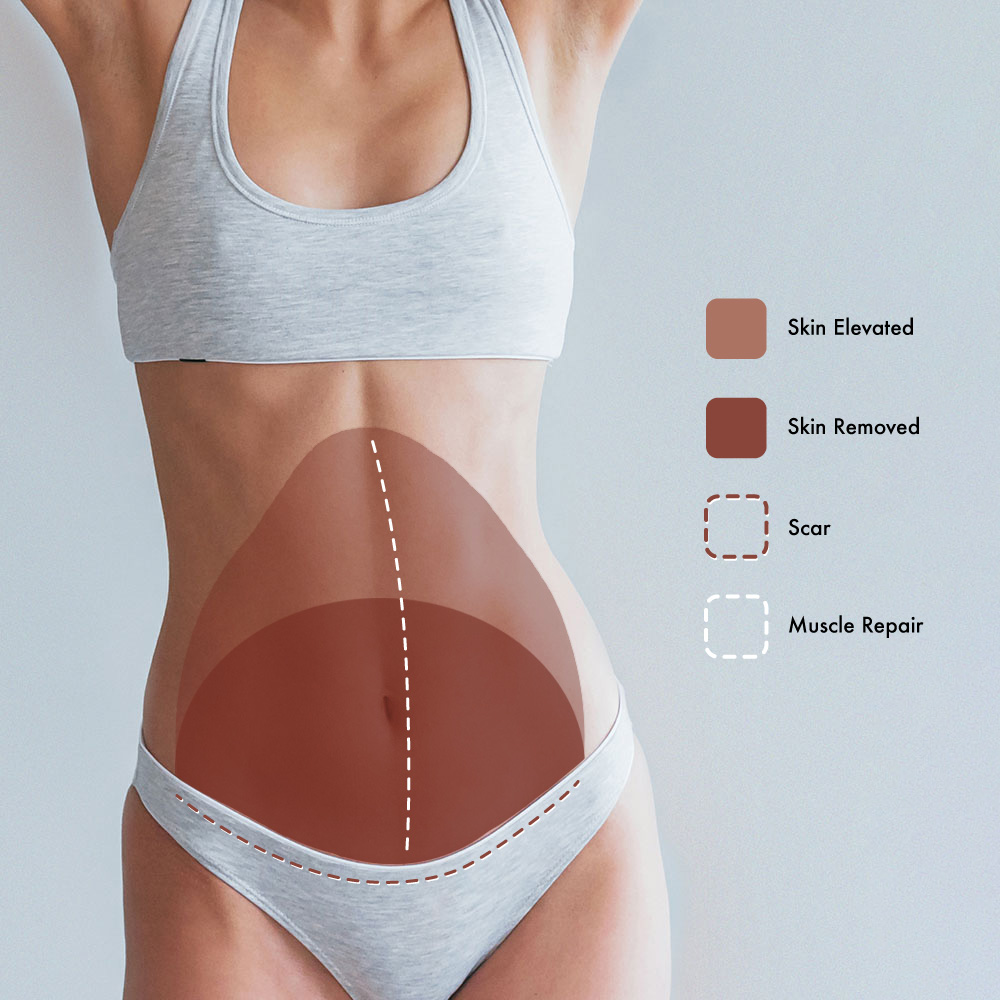 Abdominal Liposuction vs. Tummy Tuck - Fort Worth, TX