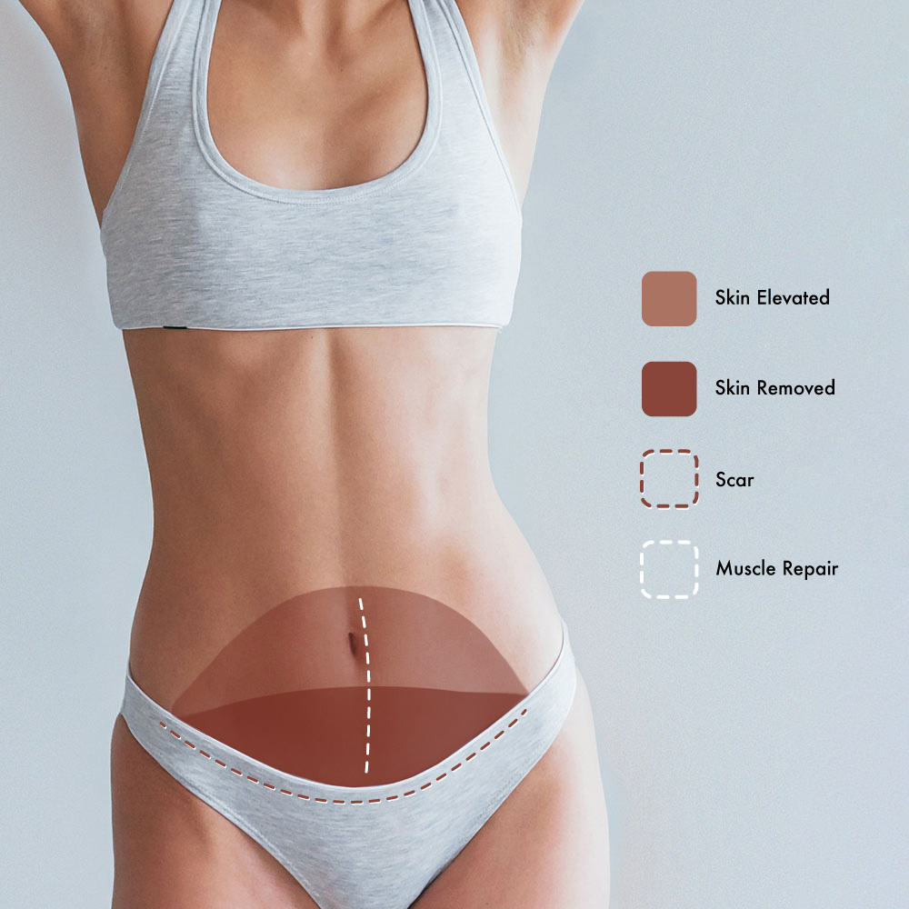 Tummy Tuck Recovery time. - Red Rose Desire Cosmetic Surgery