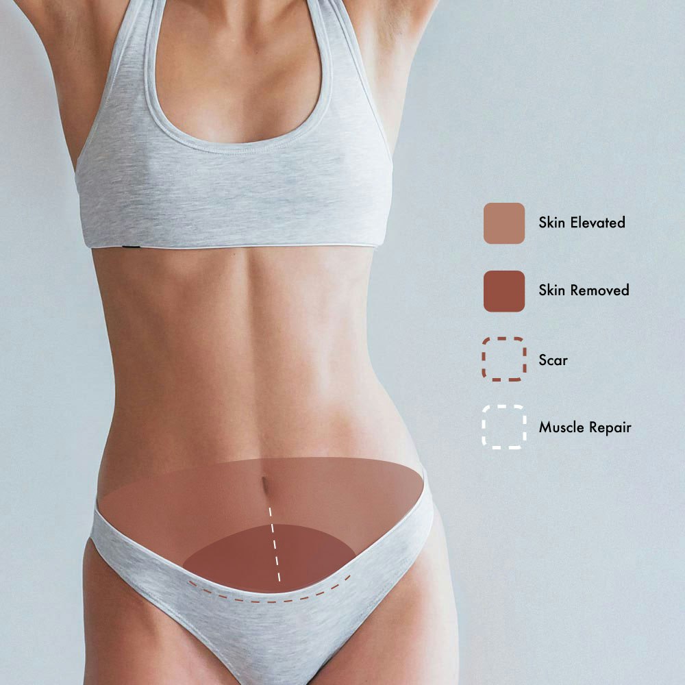 Mini Tummy Tuck diagram of skin elevated, skin removed, scar lines, and muscle repair.