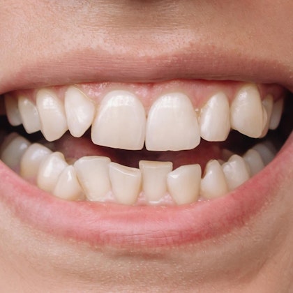 How to Achieve Straighter Teeth With a Smile Makeover - Chamblee Dental  Care Chamblee Georgia