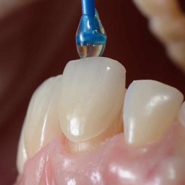 Porcelain Veneer placement