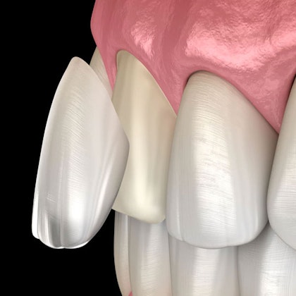 Veneer over a front tooth
