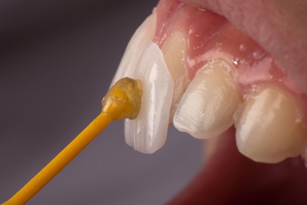 veneer being applied to tooth