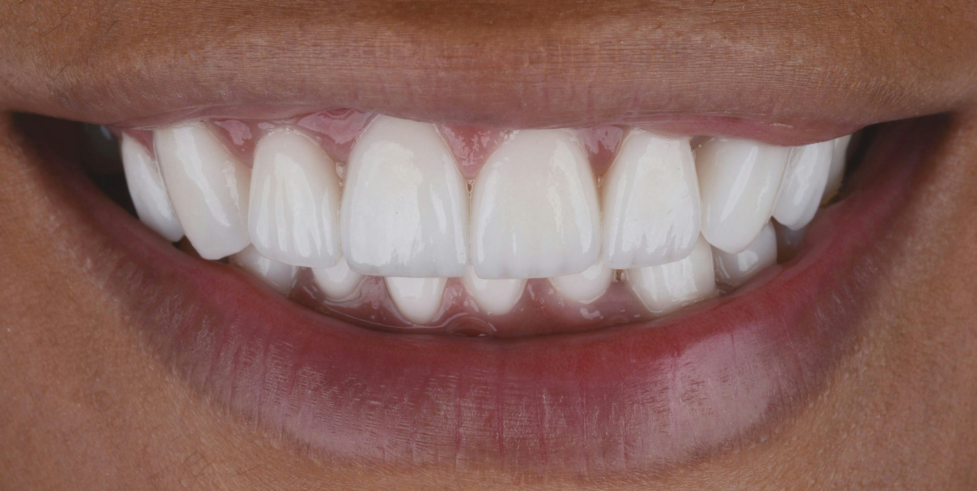 Dr. Yamen Akhras's patient after veneers procedure