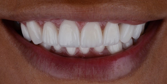 After image of perfect teeth