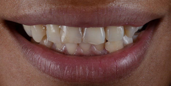 Before image of stained and cracked teeth