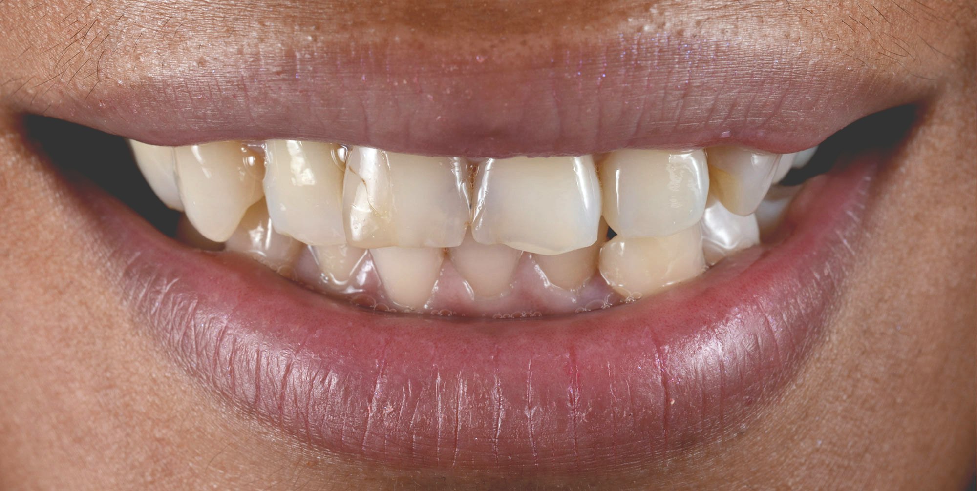 Veneers Anchorage, AK Midnight Sun Dental