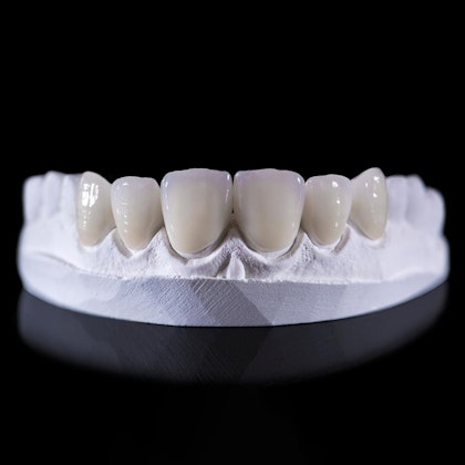 Veneers on clay model