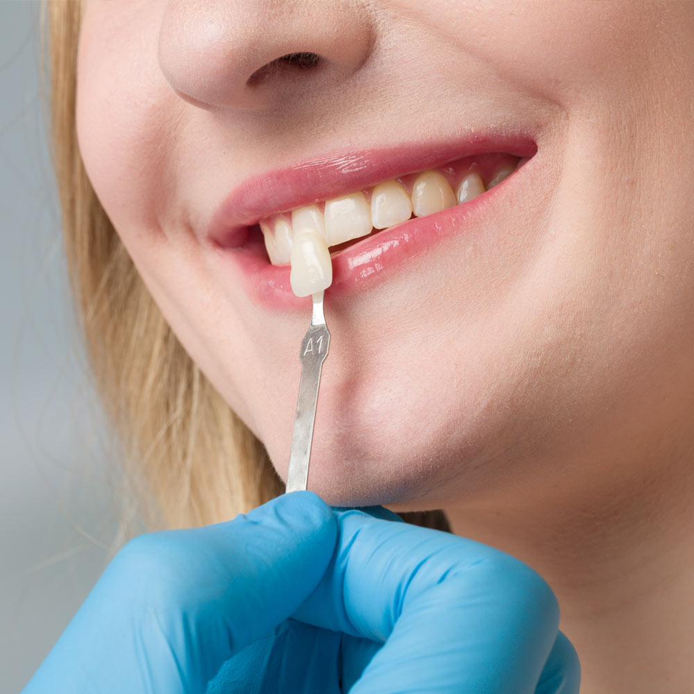 woman getting color matched for veneers