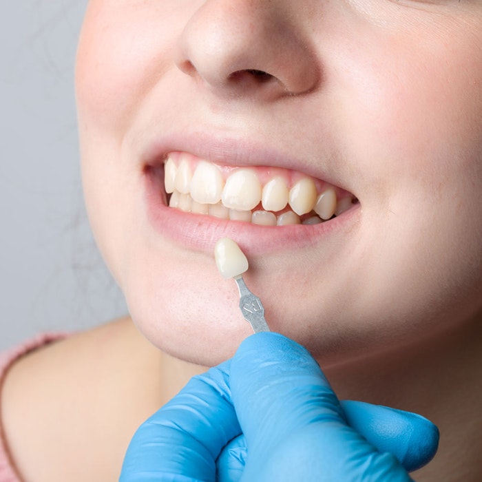 Dentist placing veneer on a tooth