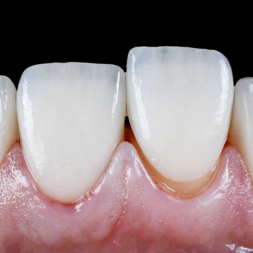Close-up of dental veneer