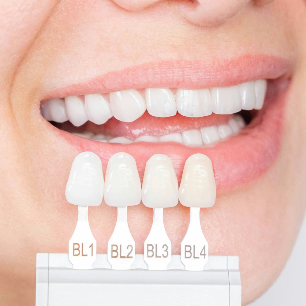 Veneer shade guide next to a woman