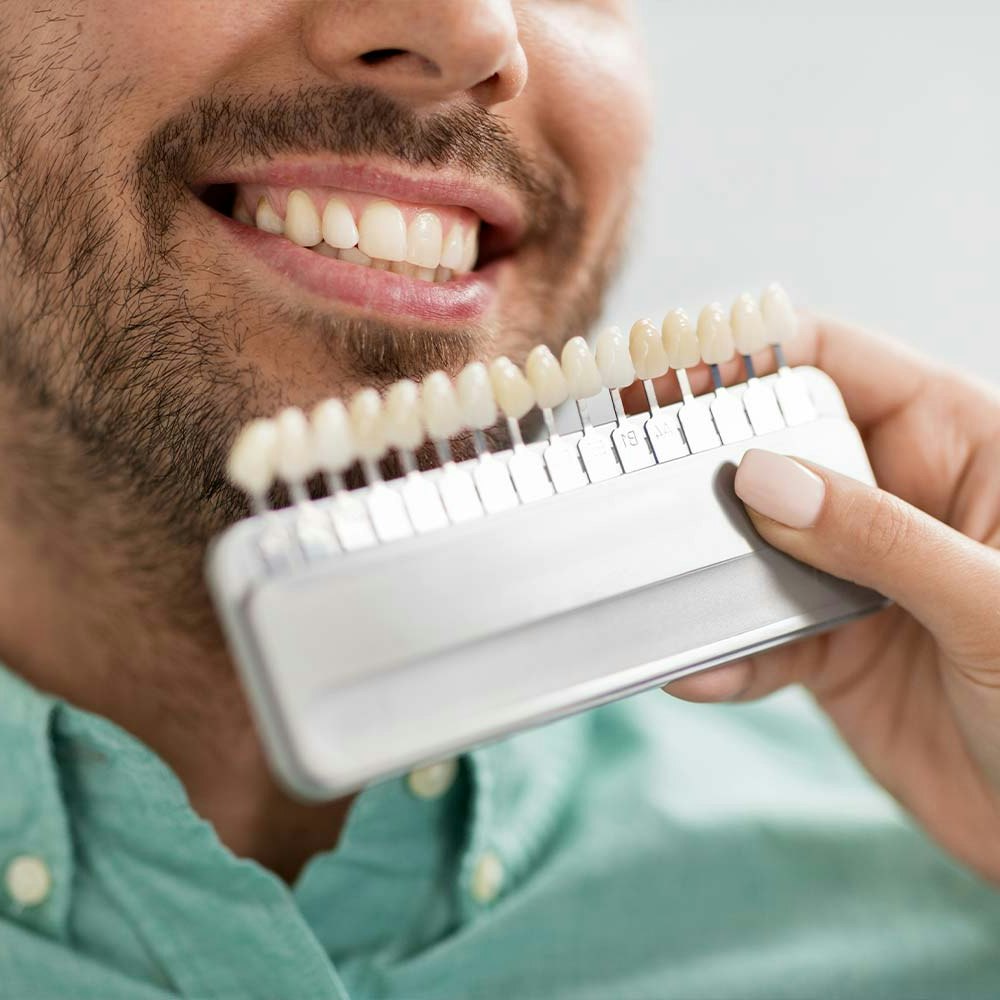 Smiling man with veneers