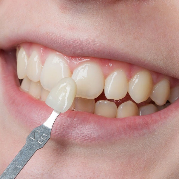 Veneer compared to teeth