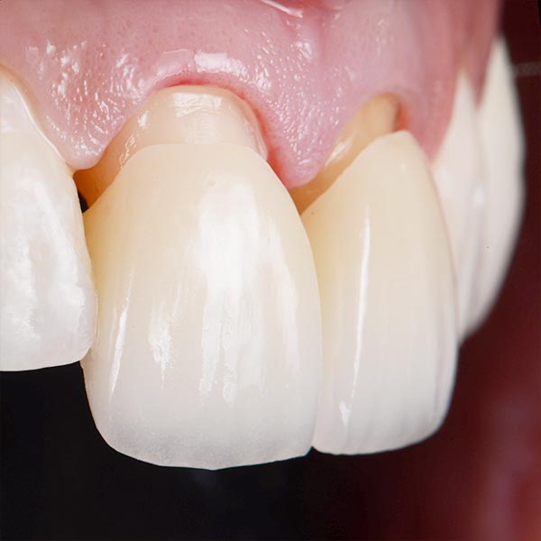 Porcelain veneers