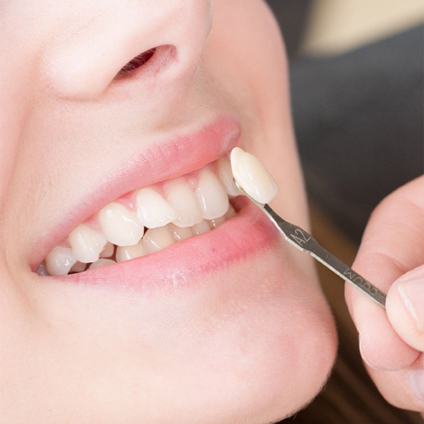 Veneer next to woman's teeth