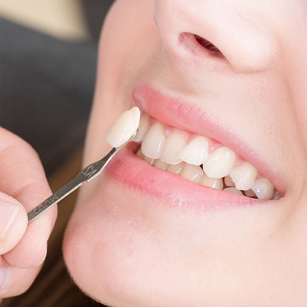Person getting veneers placed