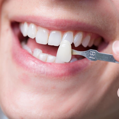 Porcelain veneers applied to smile