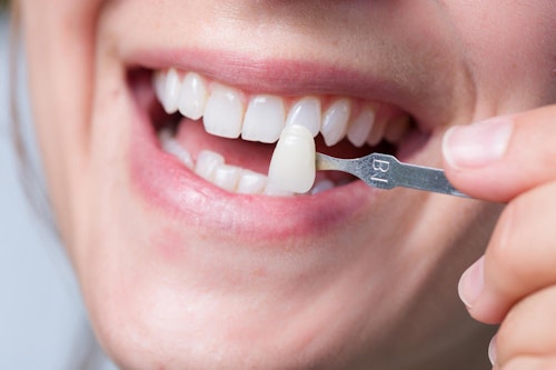 Porcelain veneers applied to smile