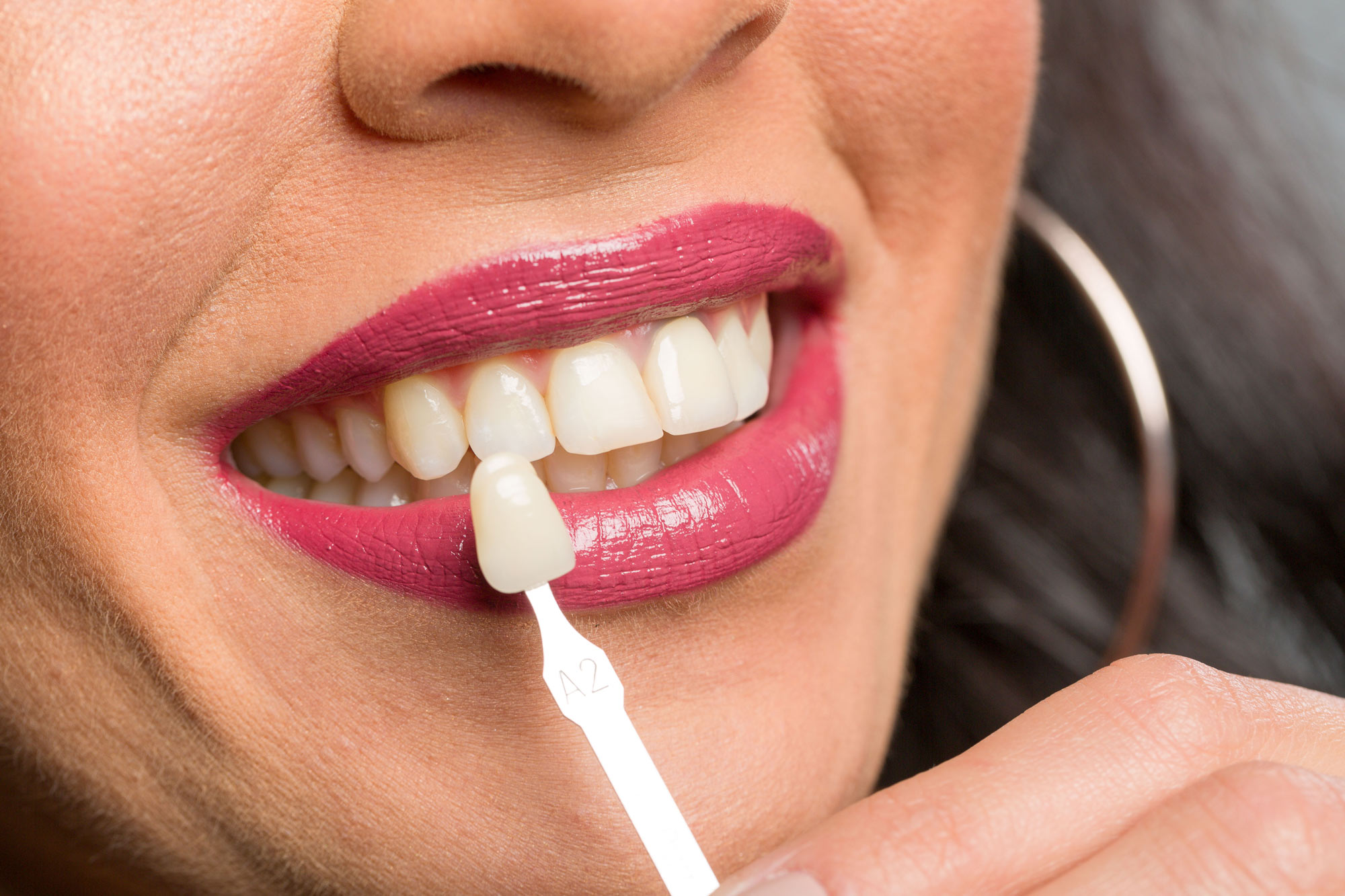 Woman smiling with veneer shade