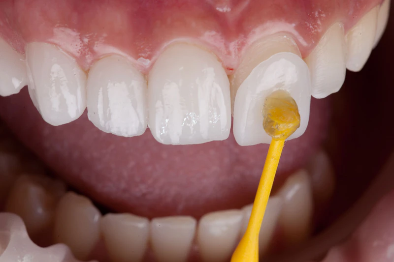 tooth receiving a veneer