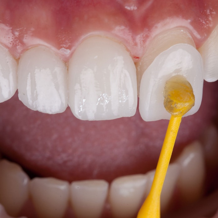 Veneer being placed on a tooth