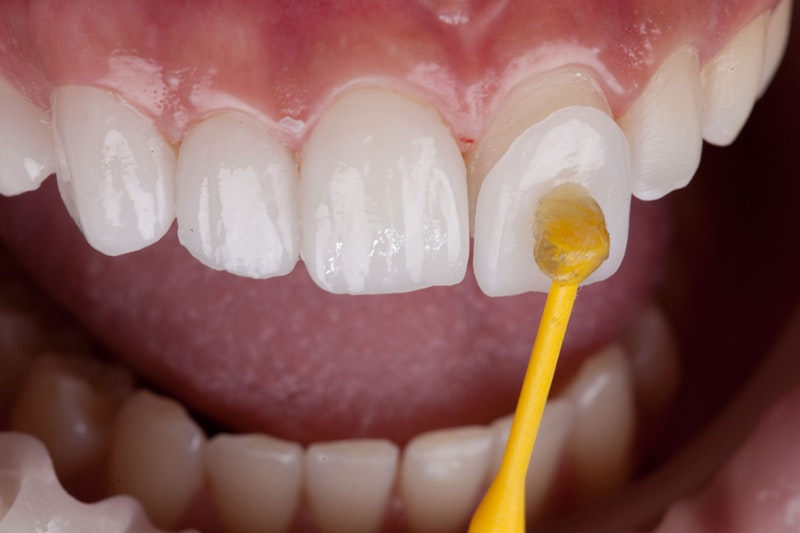 tooth receiving a veneer