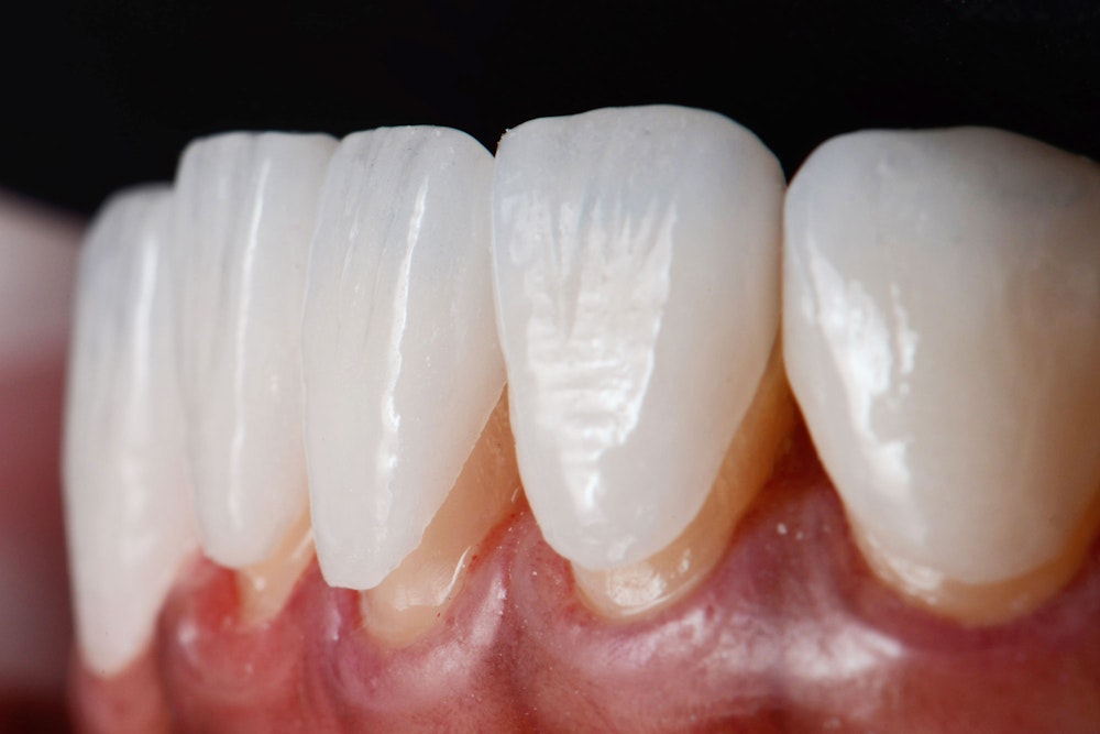 Veneers placed over teeth