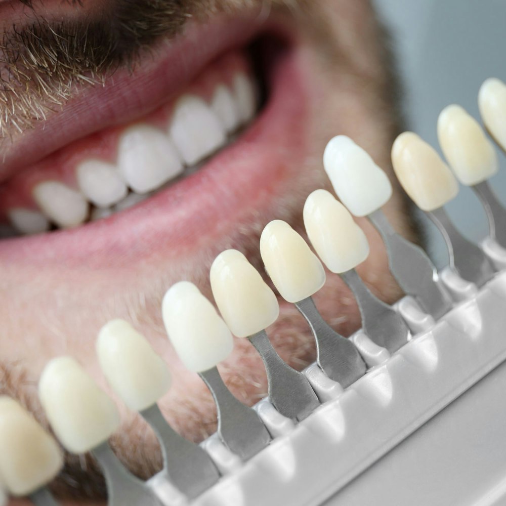 Man smiling with veneer shades