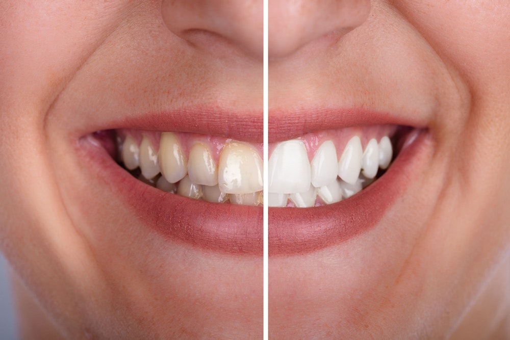 Before and after teeth whitening