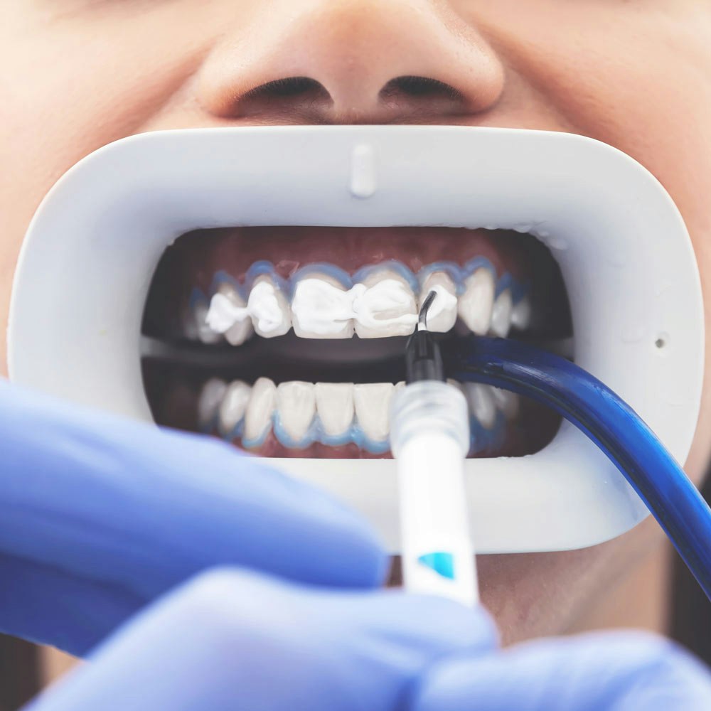 Close up of whitening gel