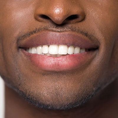 Close up of teeth whitening