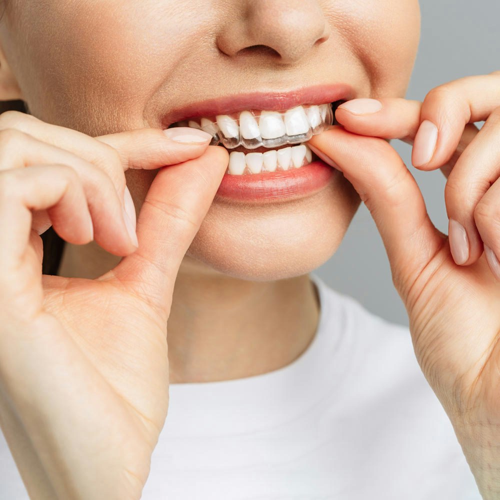 Take-home whitening kit